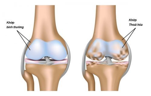 Điều trị thoái hóa khớp gối nhờ đi xe đạp - Ảnh 1
