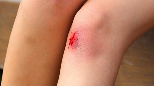 Một số chấn thương nhẹ, ảnh hưởng khi đi xe đạp và cách xử lý - Ảnh 2